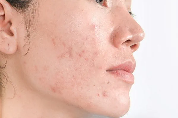 Know About Hyperpigmentation & Melasma Treatment Cure