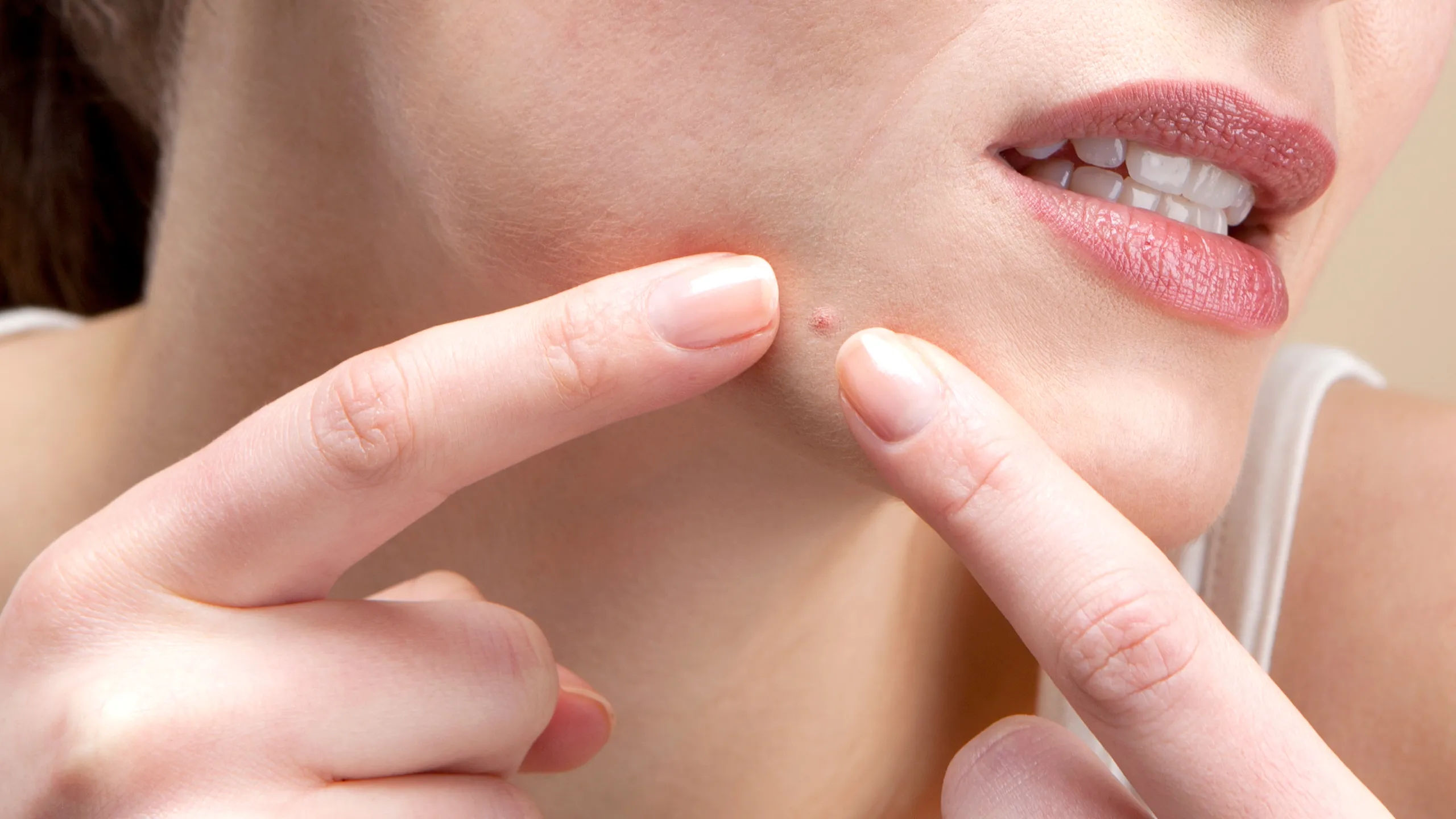 Top 10 Tips To Remove Pimples
