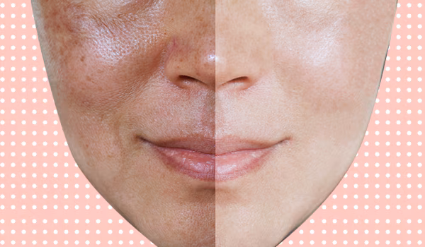 Known About Open Pores, Ageing Skin Correlation Treatment